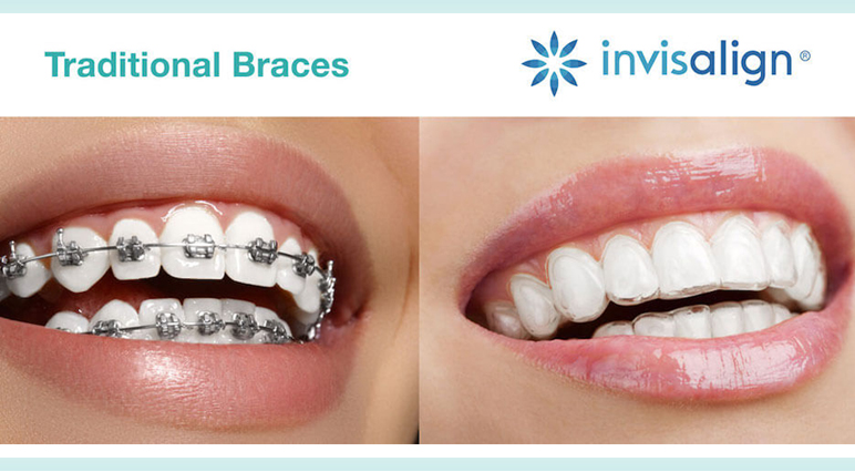 traditional vs invisalign braces