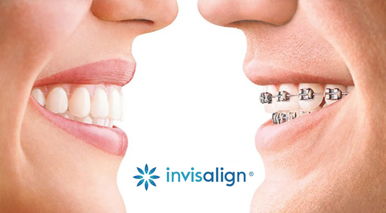 why choose invisalign